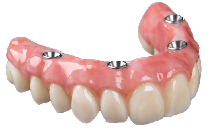 Implant Retained Dentures San Jose, CA