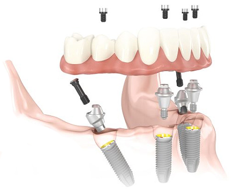 All On 4 Dental Implant Dentures San Jose, CA