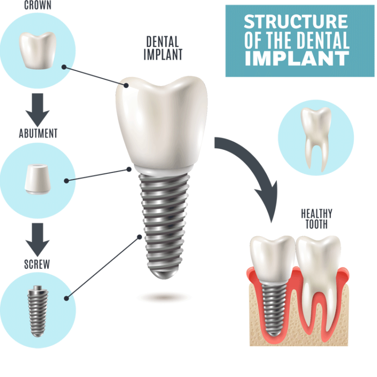 San Jose Dental Implants