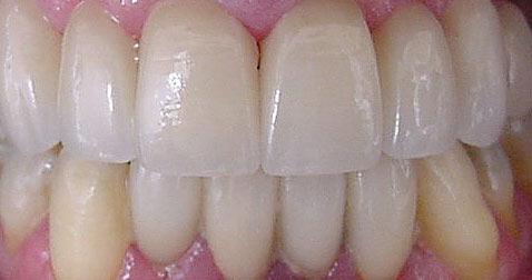 Porcelain Teeth Veneers San Jose