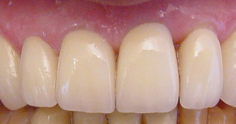 Teeth Veneers San Jose