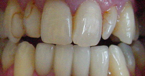 Porcelain Dental Veneers San Jose